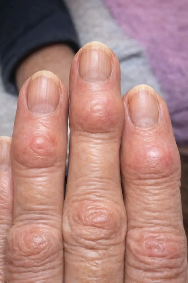 Hard Bumps on Finger Joints Near the Nails: What They Could Mean and Natural Support Drink