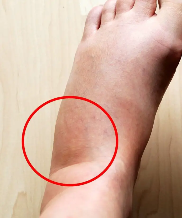 Swollen Feet: What It Means and Why It Happens
