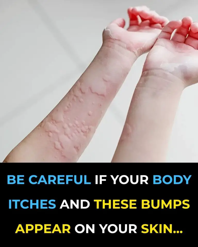 Surprising Causes Of Hives Revealed — What May Be Triggering Your Skin Reaction