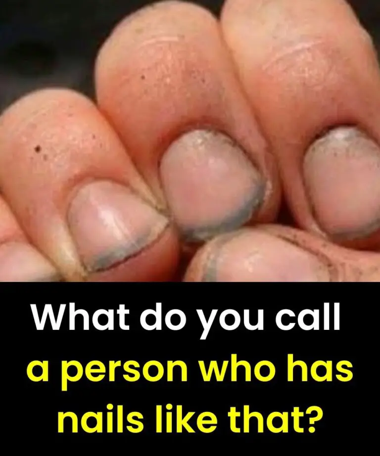 What Fingernail Color Changes May Be Trying to Tell You