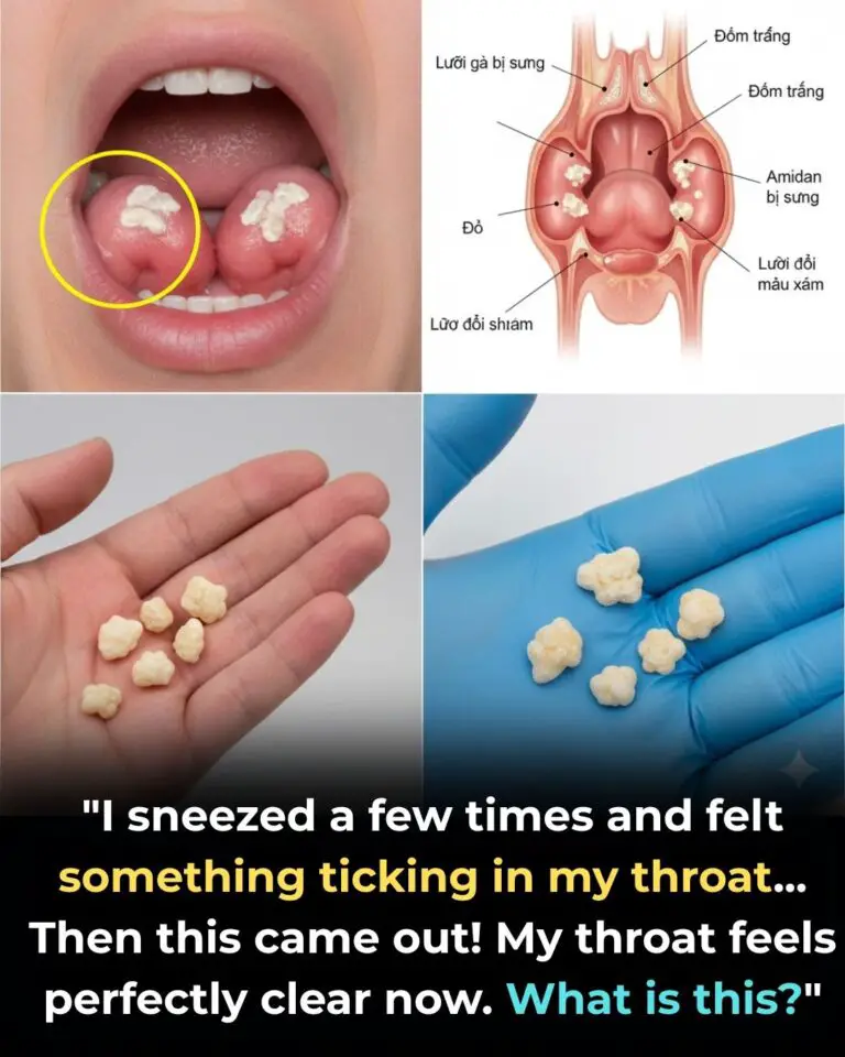 Here’s What You Need to Know About Tonsil Stones