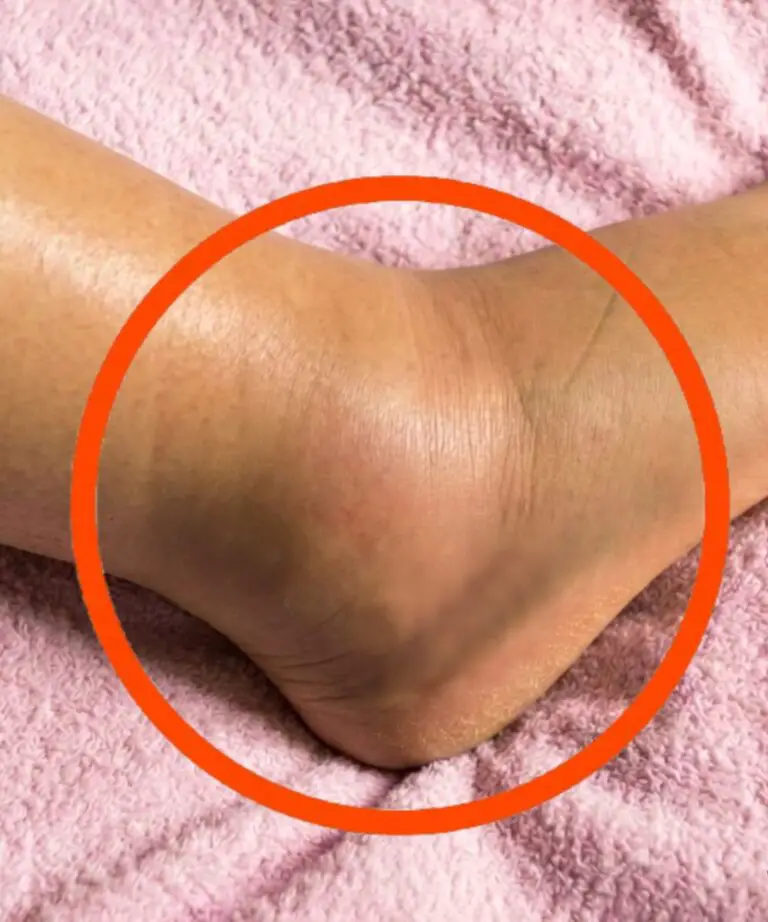 Swollen Legs: What Could It Mean?