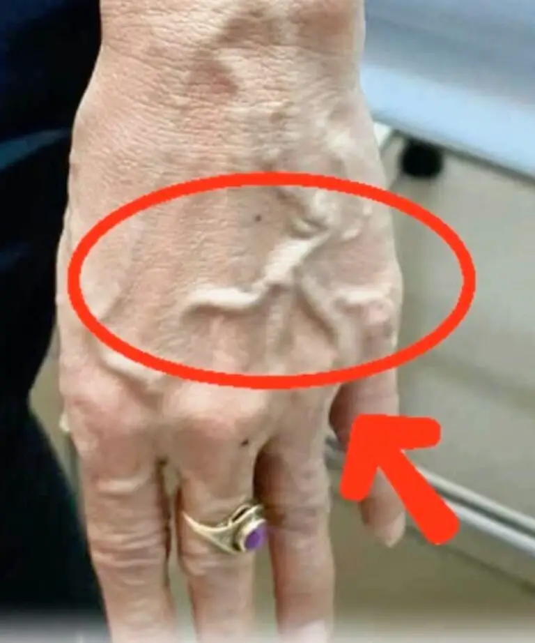 Visible Veins: Do They Mean Poor Circulation?