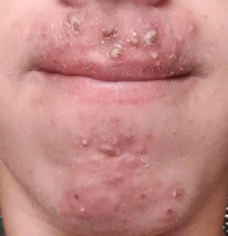 Pimples Around the Mouth: Causes, Easy Fixes & Best Skincare Routine for Clear Skin