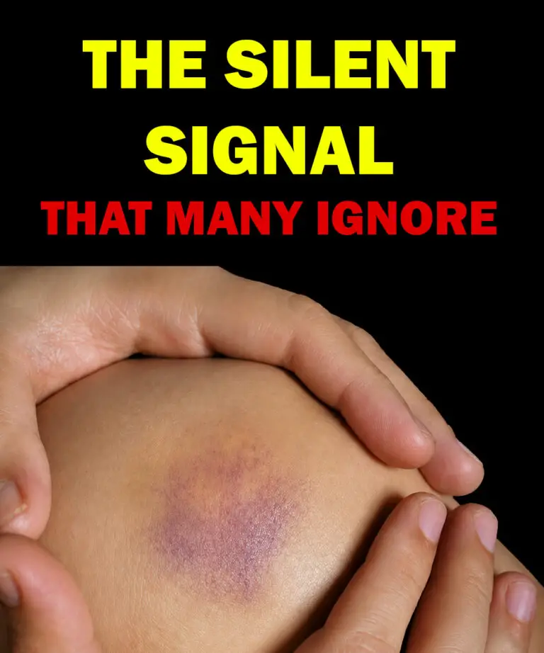 The Silent Signal That Many People Ignore: What Unexplained Bruising Could Mean