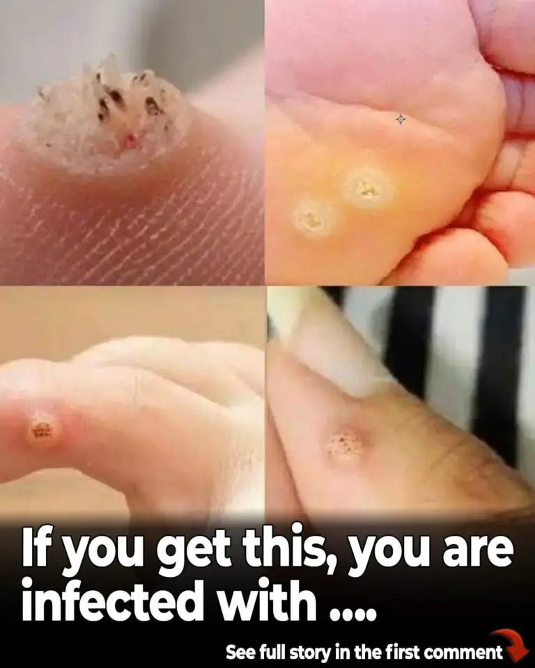 6 Types of Warts: Signs, Symptoms, Home Remedies, and Treatment