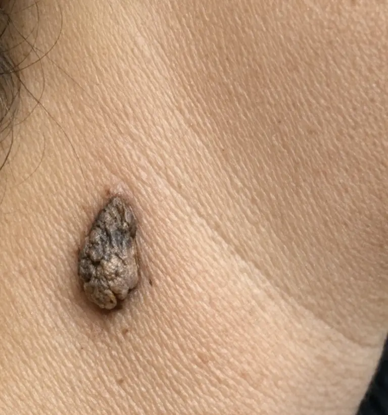 Rub This 1 Mixture on Your Neck and Get Rid of Skin Tags, Dark Patches, and Rough Texture
