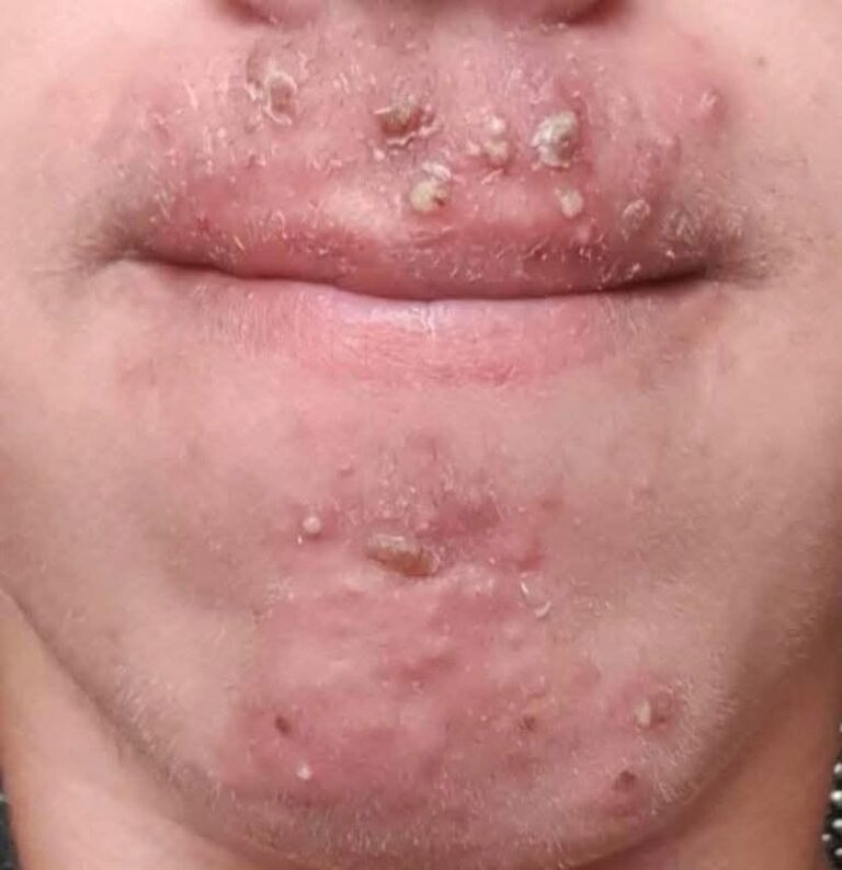 Pimples Around the Mouth: Causes, Easy Fixes, and the Best Skincare Routine for Clearer Skin