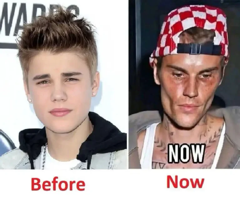 Why Does Justin Bieber Look Different Recently? What We Actually Know About His Health, Recovery, and Life in the Spotlight