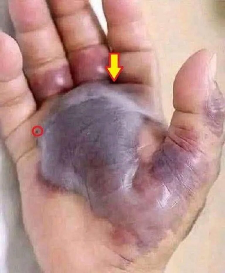 ATTENTION: Early Signs of an Infected Cut or Insect Bite Everyone Should Know