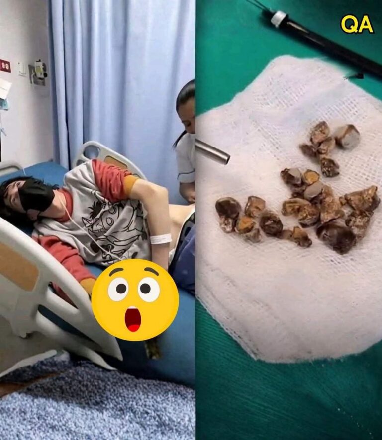 Kidney Stones: Understanding the Signs, Causes, and Prevention