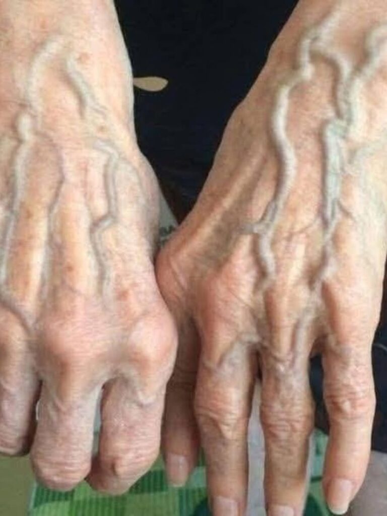 If This Sign Has Appeared for a Week: What Suddenly Prominent Hand Veins May Mean