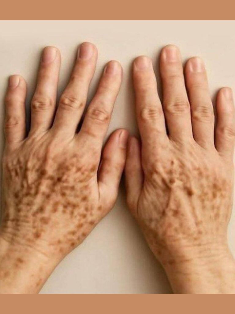 Spots on the Hands: Are They Signs of Melanoma — The Most Dangerous Form of Skin Cancer? Mediterranean Lemon Chicken Bowl