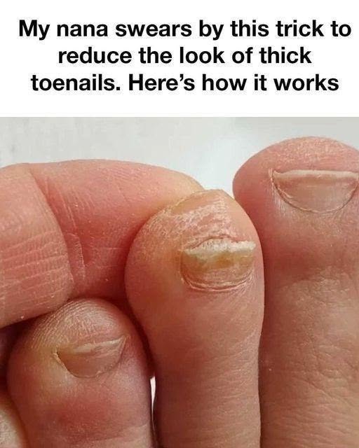 Great! Thank You, Grandma! The Gentle Way to Soften Thick Toenails at Home