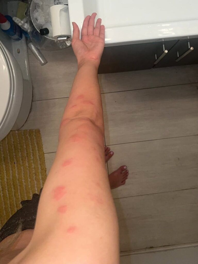 How To Identify 10 Of The Most Common Bug Bites – Know What Bit You & When to Worry