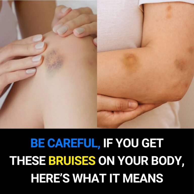 If You Get These Bruises on Your Body… Here’s What It Means