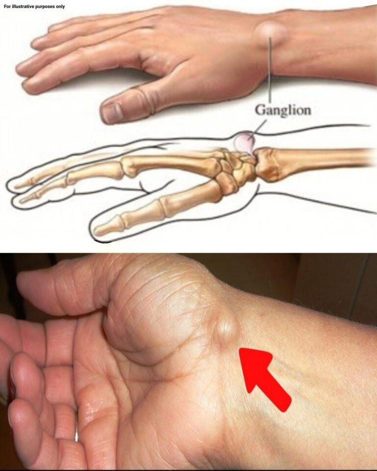 Noticing a Lump on Your Hand? Here’s What You Need to Know — When to Worry (and When Not To)