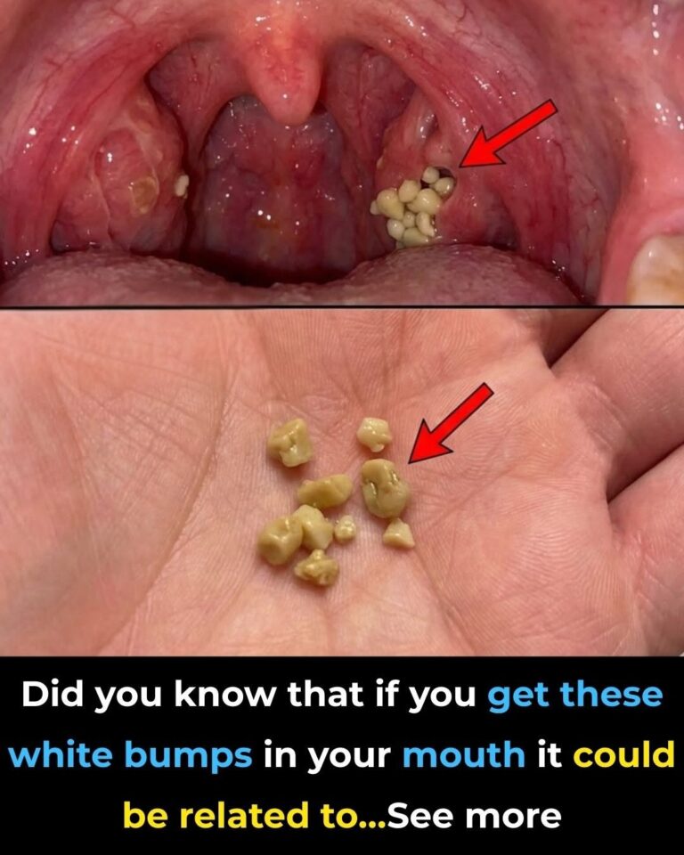 Tonsil Stones: What They Are, How to Remove Them Safely, and Why “Forever” Isn’t Realistic (But Relief Is!)