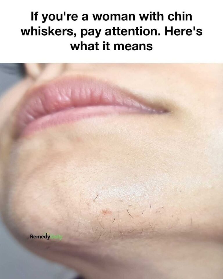 Chin Whiskers in Women: What’s Normal and When to Pay Attention