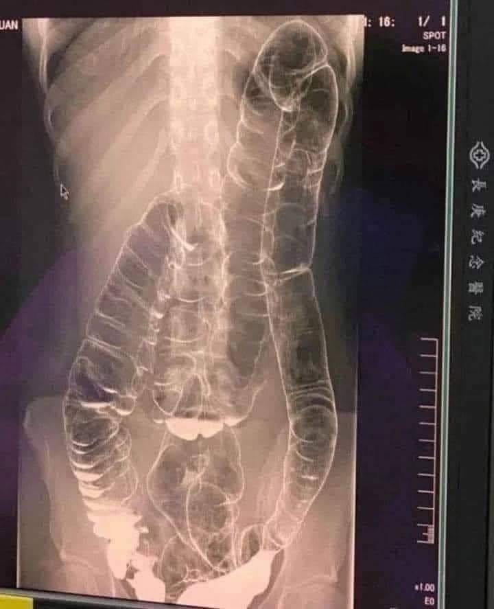 Severe Constipation and Toxic Megacolon: Causes, Warning Signs, and When to Seek Help