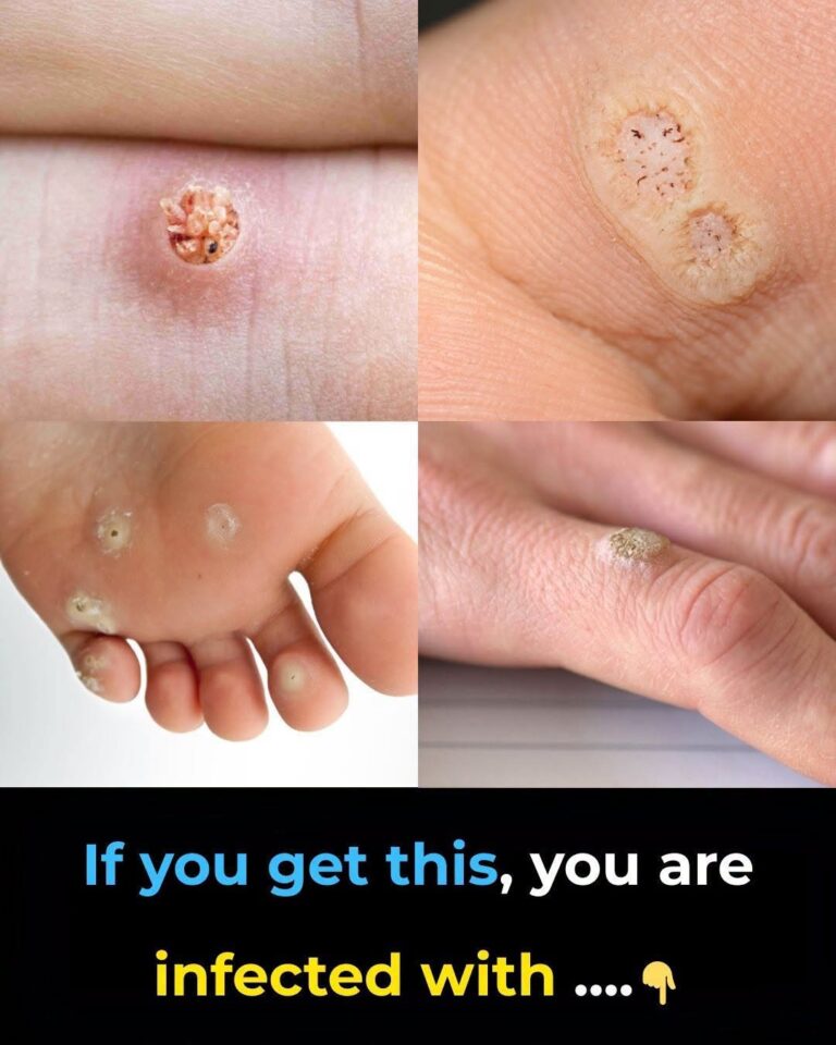 6 Types of Warts Explained: Signs, Symptoms, and Safer Home Care