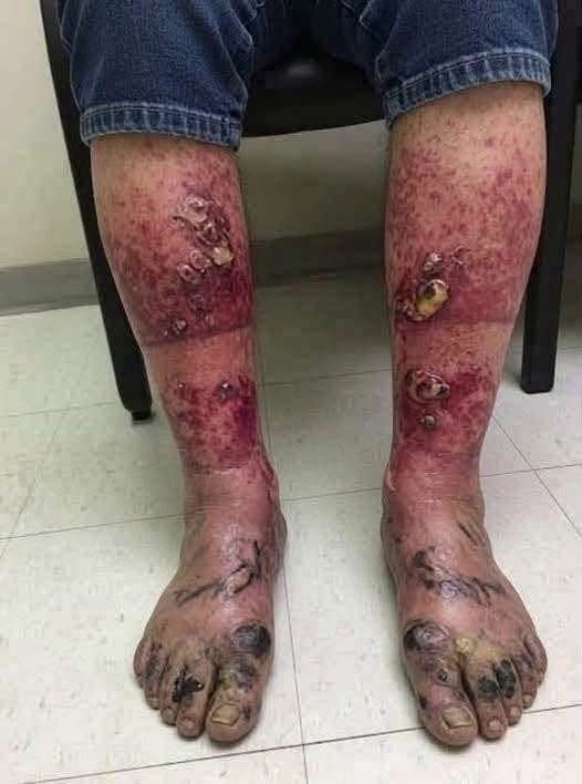 Black Toes, Open Sores, and a Purple Rash: Why These Foot Symptoms Need Urgent Medical Care