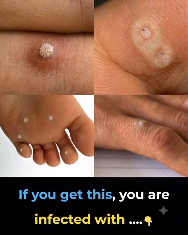 6 Different Types of Warts—How to Tell Them Apart and When to Seek Treatment