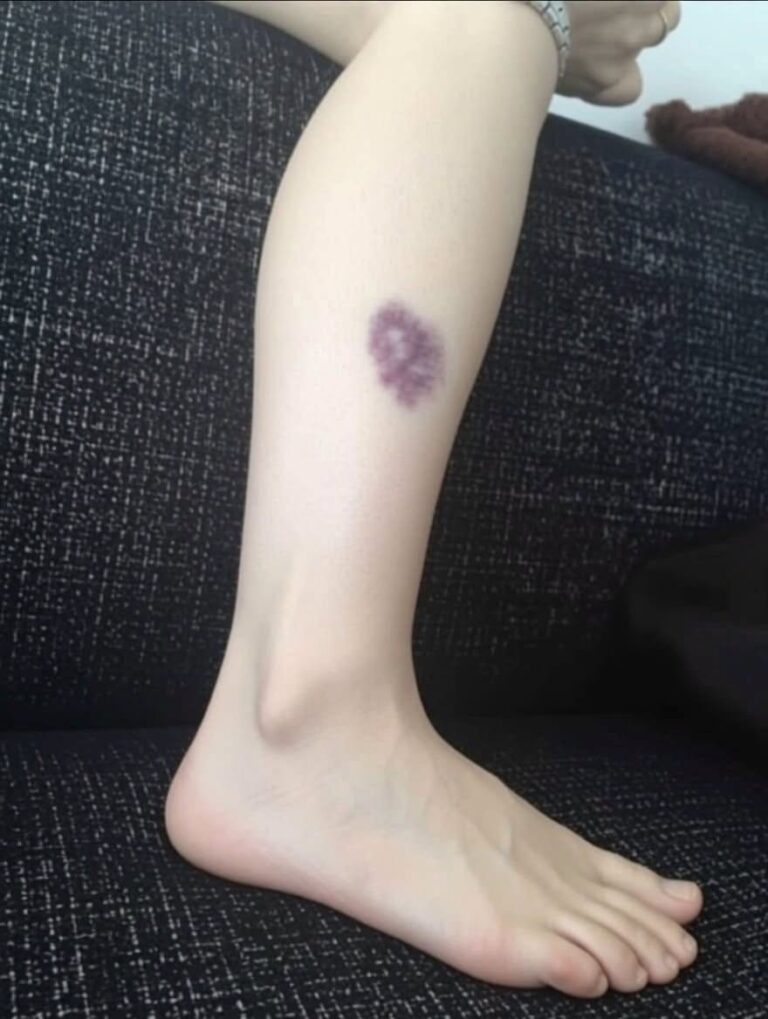 Be Careful If You Get These Bruises on Your Body: What Unexplained Bruising May Mean