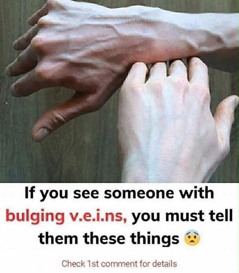 If You Notice Bulging Veins, Here’s What Your Body Might Be Trying to Tell You