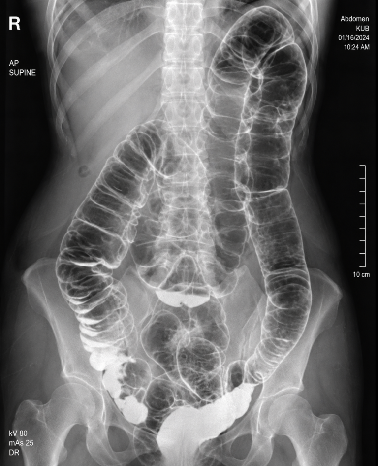 Severe Constipation and Toxic Megacolon: Causes, Warning Signs, and When to Seek Help